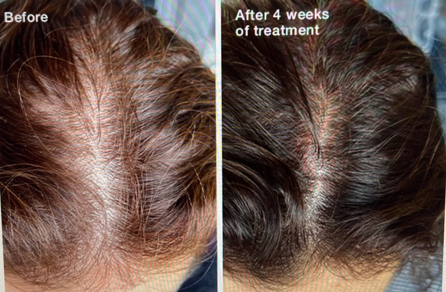 Traitement Intensif Chute de cheveux - Cure de 1 mois