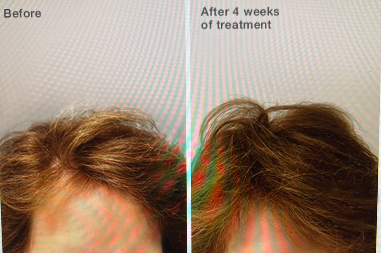 Traitement Intensif Chute de cheveux - Cure de 1 mois